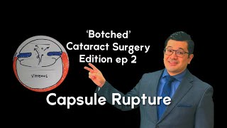 ‘Botched’ Cataract Surgery Edition Posterior Capsule Rupture Explained [upl. by Onailime549]