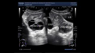 Ultrasound Video showing Two types of Ovarian Cysts and an Ovarian Mass [upl. by Kamin186]