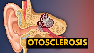 OTOSCLEROSIS Causes Signs and Symptoms Diagnosis and Treatment [upl. by Ecyor]