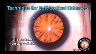 CataractCoach 1100 technique for very soft PSC cataract surgery [upl. by Nyl]