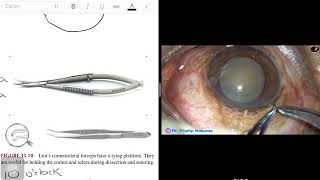 Small Incision Cataract Surgery  Manual StepbyStep [upl. by Enitram]