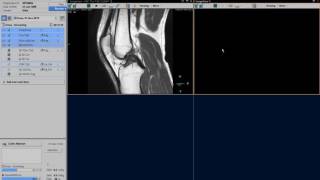 Clinical applications video  Ingenia Knee imaging [upl. by Gemoets]