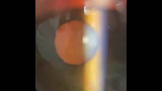 Posterior subcapsular cataract PSC  Slit lamp retro illumination [upl. by Alviani]