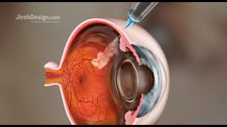 Intravitreal Injection Animation HD [upl. by Huey]