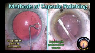 capsule polishing methods in cataract surgery [upl. by Sanez]