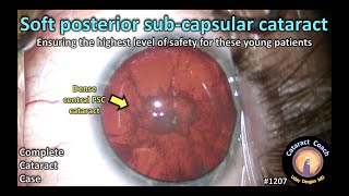 CataractCoach 1207 soft posterior subcapsular PSC cataract [upl. by Airod]