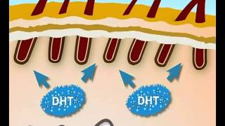 ¿QUE ES LA ALOPECIA ANDROGENETICA [upl. by Ellita]