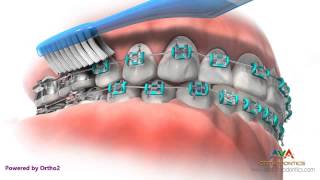 Life with Braces  Brushing amp Flossing [upl. by Venice]