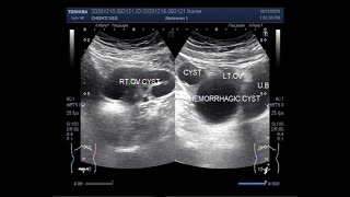 Ultrasound Video showing Ovarian Cysts simple Hemorrhagic and complex ones all in one patient [upl. by Einalem836]