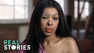 ACID ATTACK My Story Crime Documentary  Real Stories [upl. by Londoner90]