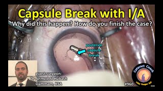 posterior capsule break during IA in cataract surgery [upl. by Colb370]